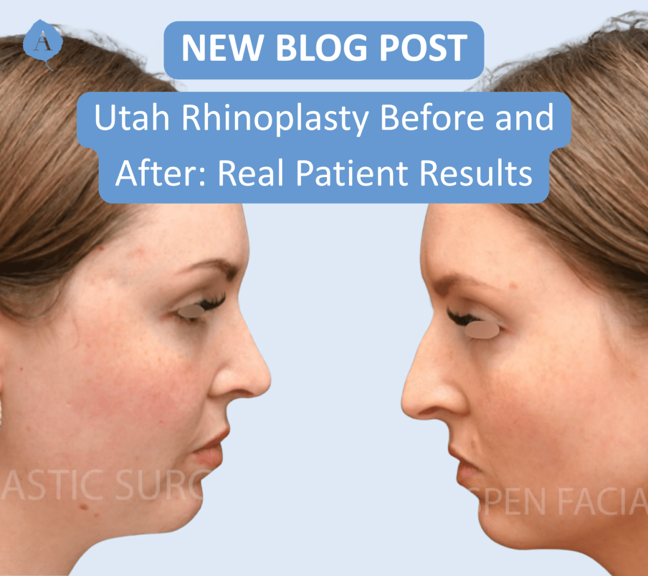 Real patient from Aspen Facial Plastics Before and After rhinoplasty
